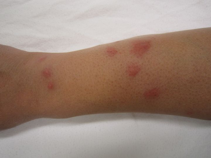 Bed Bug Bites are often in lines